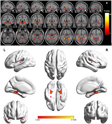 Reduced inter-hemispheric auditory and memory-related network interactions in patients with schizophrenia experiencing auditory verbal hallucinations